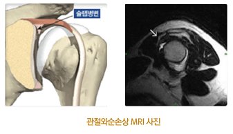 관절와순손상 MRI 사진